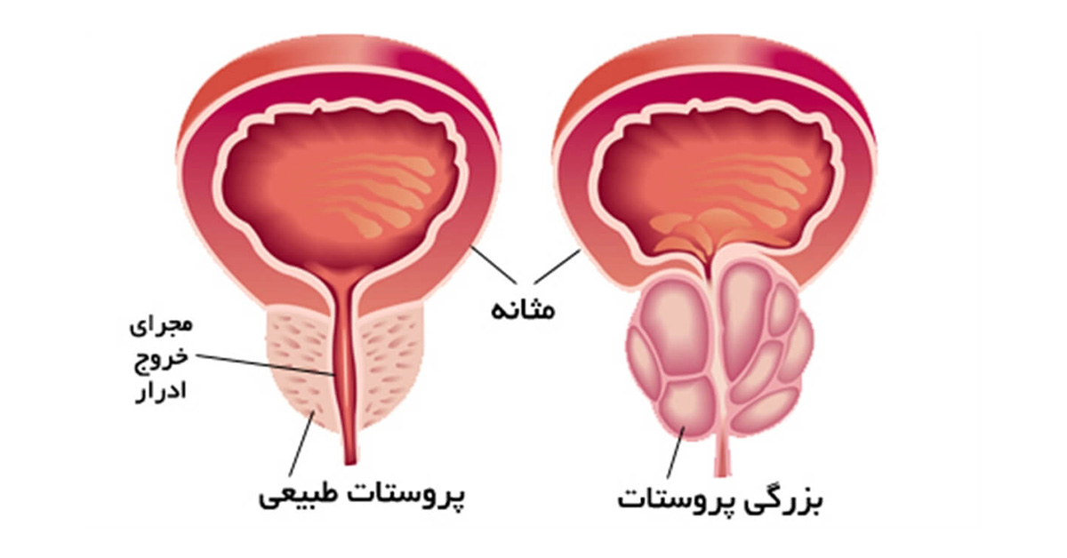 هایپرپلازی پروستات