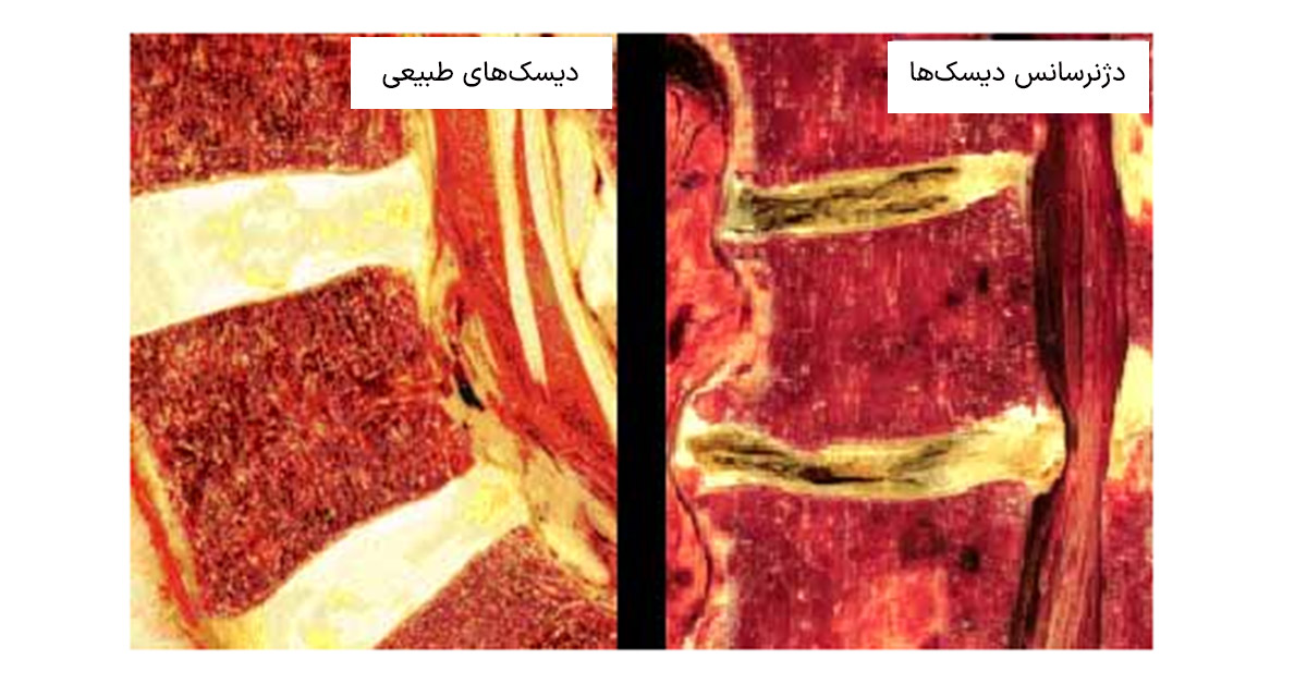 Картина начальных дистрофических изменений. Жировая дегенерация костного мозга по типу Modic 2. Жировая дегенерация костного мозга. Жировая дегенерация позвонков. Жировая перестройка тел позвонков.