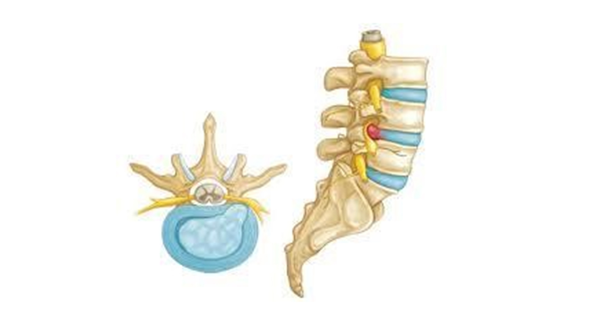 فتق دیسک بین مهره‌ای‌ در کمردرد