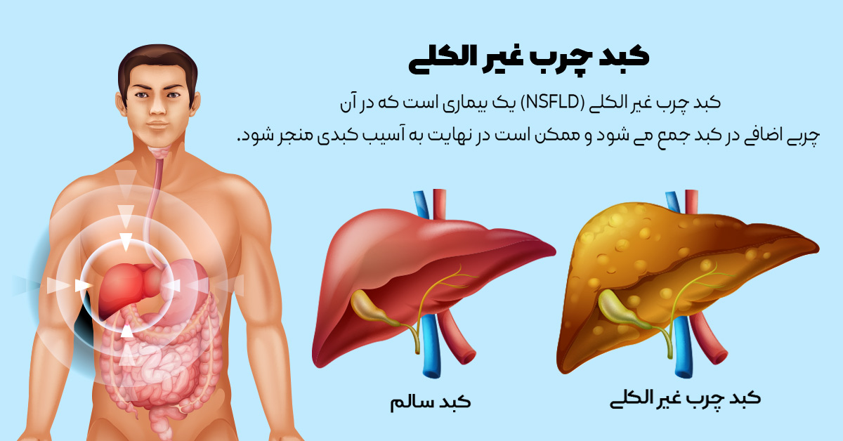 کبد چرب چیست