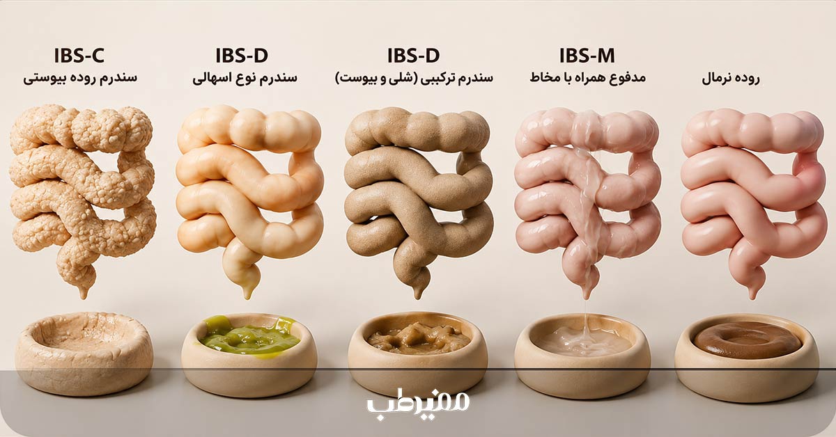 تغییر رنگ مدفوع در سندروم روده تحریکپذیر